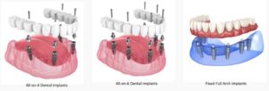 Learn about your options for dental implants in Savannah, GA